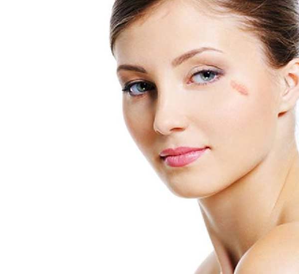 Birthmark Removal in Kanpur
