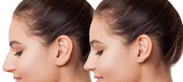 Buccal Fat Removal in Kanpur