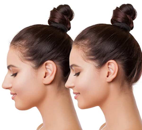 Buccal Fat Removal in Kanpur
