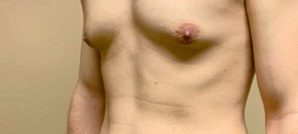 Male Breast Removal in Kanpur