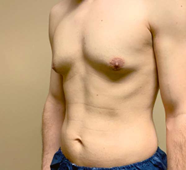 Male Breast Removal in Kanpur