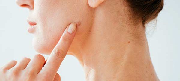 Moles Removal in Kanpur