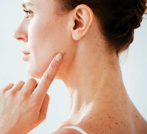 Moles Removal in Kanpur