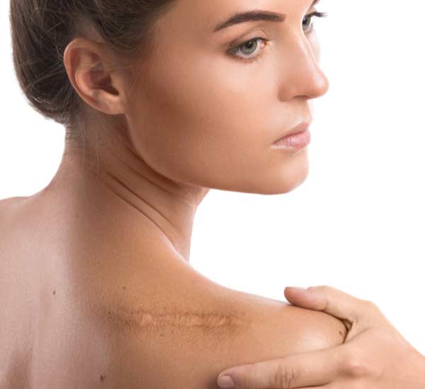 Scar Treatment in Kanpur