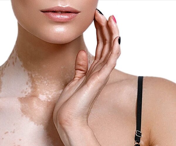 vitiligo treatment in Kanpur