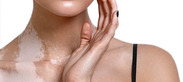 vitiligo treatment in Kanpur